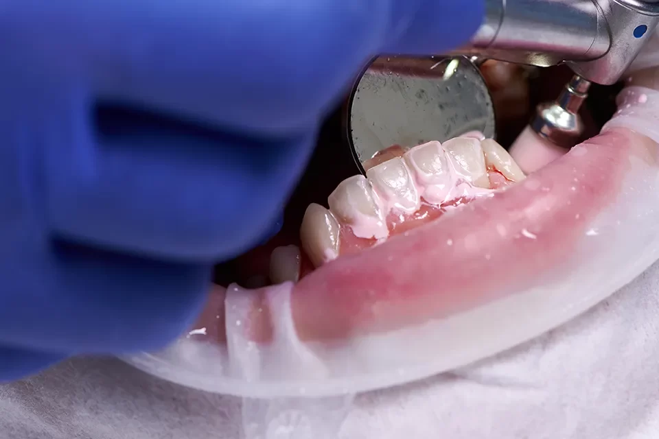 Dental Cleaning