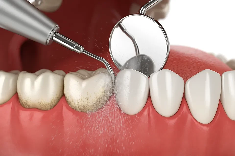 Dental Cleaning