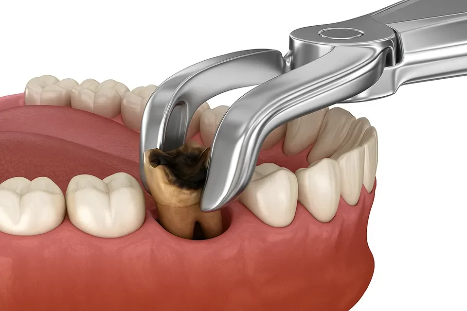 Dental Extraction
