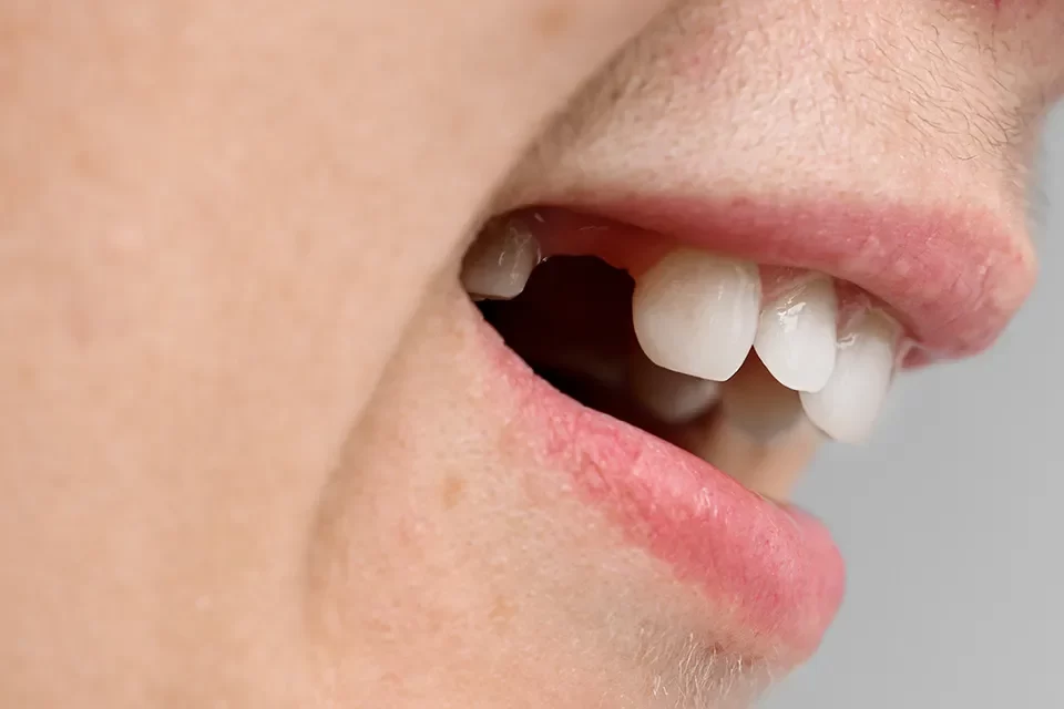 Dental Extraction