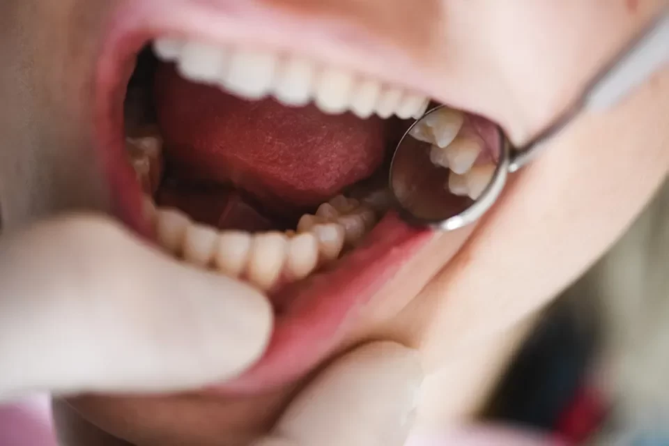 Dental Fillings