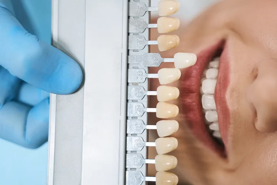Dental Veneers