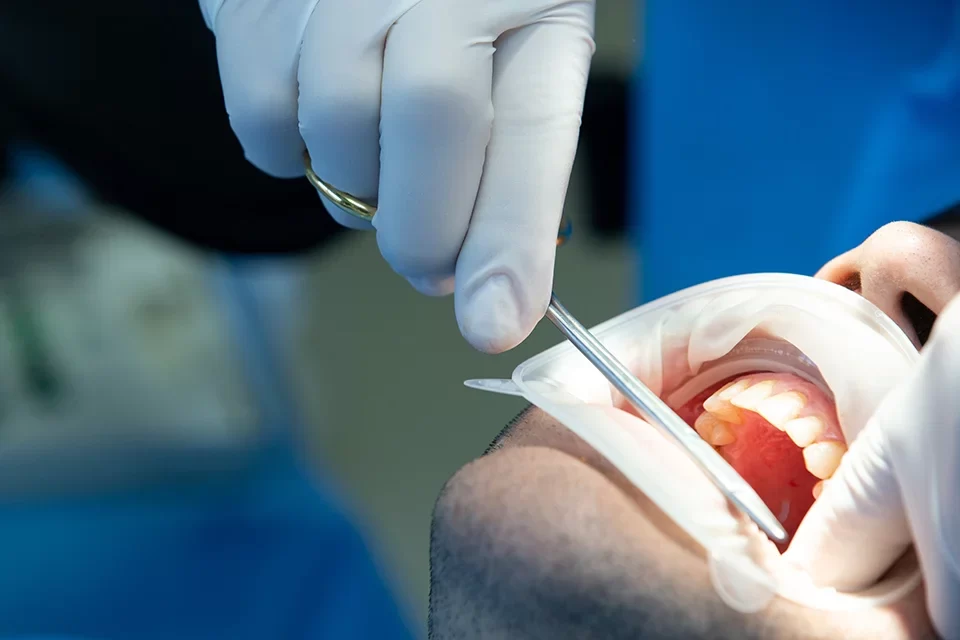 Gentle Root Canal Treatment in Toronto Gentle Root Canal Treatment in Toronto