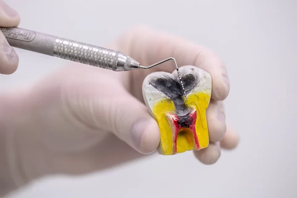 Gentle Root Canal Treatment in Toronto Gentle Root Canal Treatment in Toronto