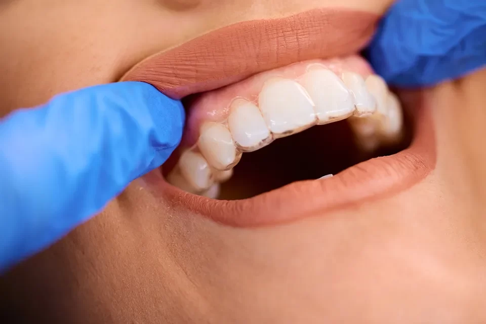 Invisalign