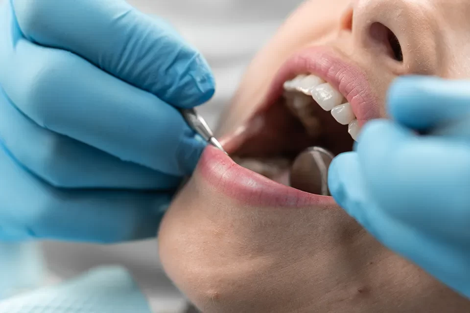Wisdom Teeth Removal